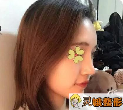 隆鼻术后果
