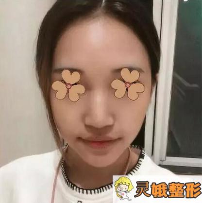 隆鼻术前照