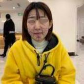 面部填充术前
