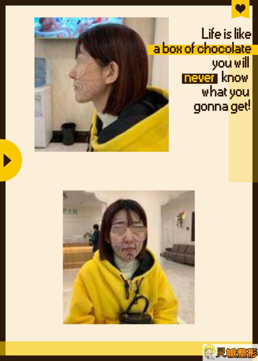 面部填充术前