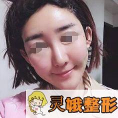 面部填充术后第3天