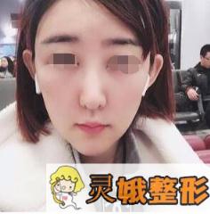 面部填充术后第18天