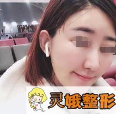 面部填充术后第18天