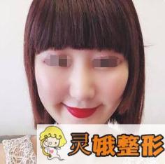 面部填充术后第23天
