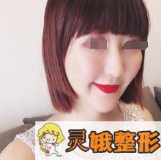 面部填充术后第23天
