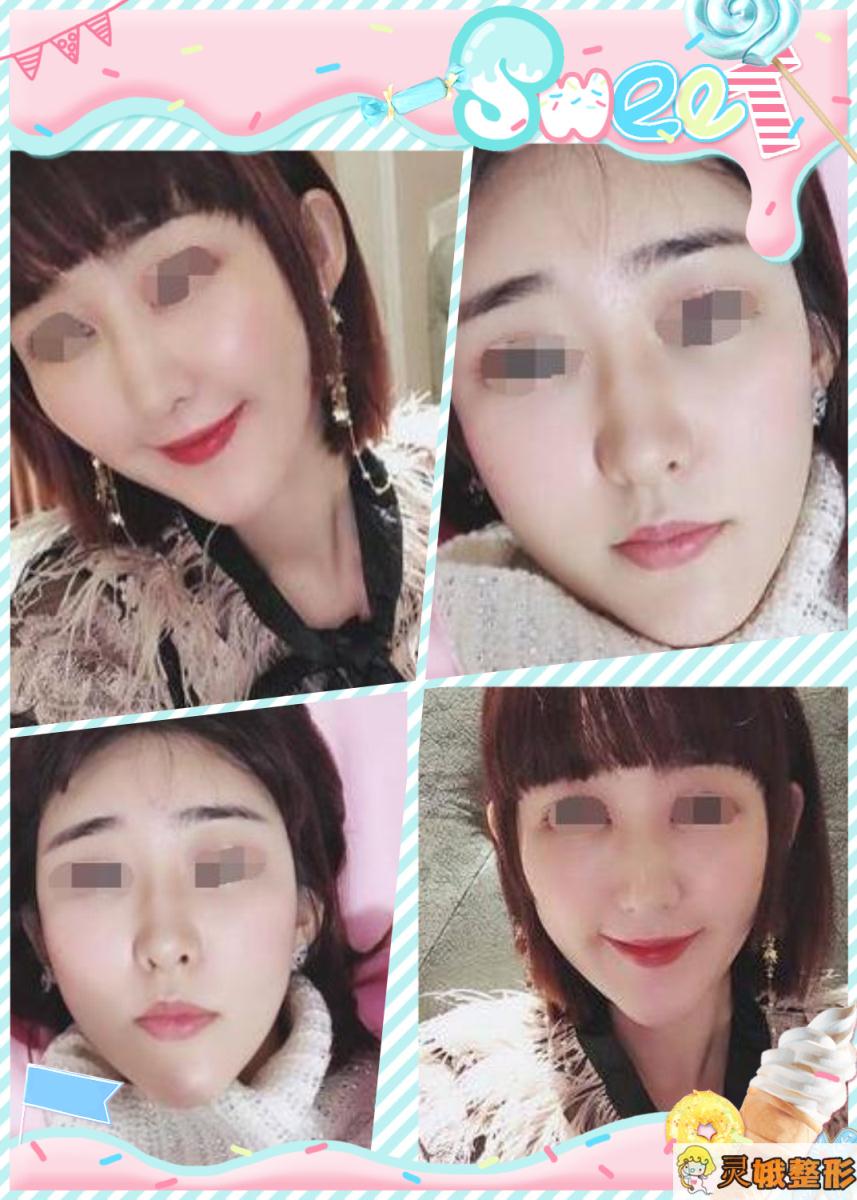 面部填充术后案例