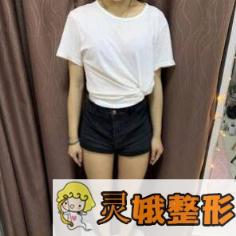 大腿吸脂术前