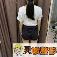 大腿吸脂术前