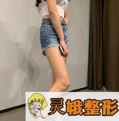 大腿吸脂术后第48天