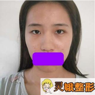 深圳阳光医院陈星光隆鼻案例图