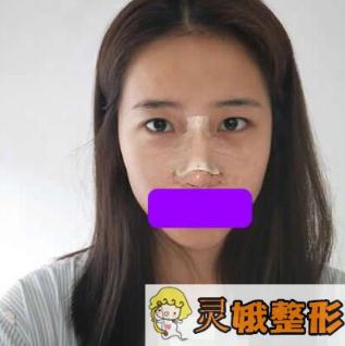 深圳阳光医院陈星光隆鼻案例图