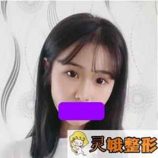 隆鼻术后恢复