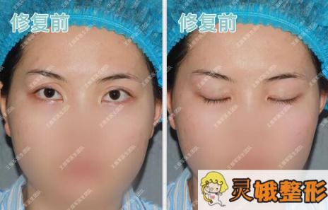 双眼皮修复前状况