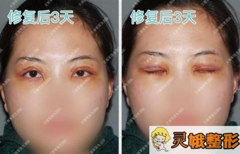 双眼皮修复后三天