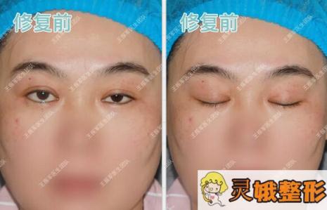 修复术前眼部情况