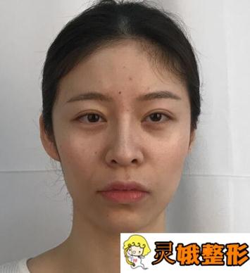 做了玻尿酸丰泪沟后，小姐姐变成元气满满小仙女