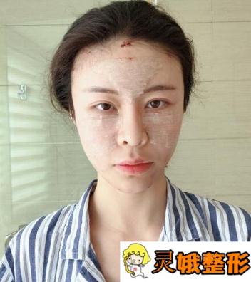 做了玻尿酸丰泪沟后，小姐姐变成元气满满小仙女