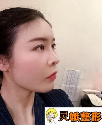 做了玻尿酸丰泪沟后，小姐姐变成元气满满小仙女