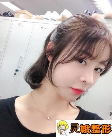 做了玻尿酸丰泪沟后，小姐姐变成元气满满小仙女