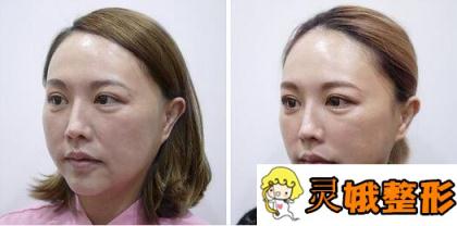 电波拉皮果图