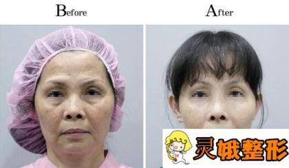 电波拉皮果图