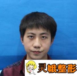 2020武汉协和医院整形外科价格表全新公布，附双眼皮日记