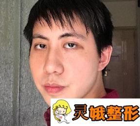 2020武汉协和医院整形外科价格表全新公布，附双眼皮日记