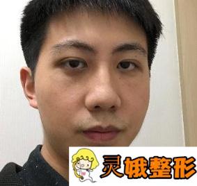 2020武汉协和医院整形外科价格表全新公布，附双眼皮日记