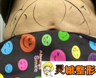 北京大学深圳医院整形外科价格表及腰腹吸脂真人案例曝光