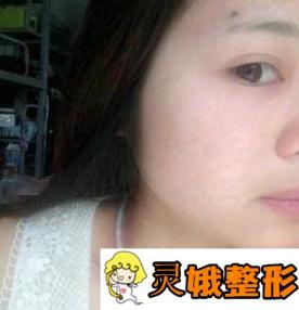 2020无锡市人民医院整形外科价格表及除痘真人案例