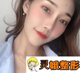 杭州阅美(原同欣)整形医院价格表，附眼部手术真实案例