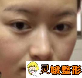 杭州悦可医疗美容医院价格表，附面部脂肪填充案例果分享