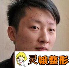 青少年痤疮引发的原因是什么？该如何调节？