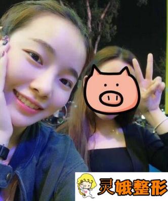 宁夏华美整形价格表震撼发布，附隆鼻案例一览