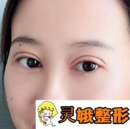 江苏省中医院整形科价格表一览，附眼部案例