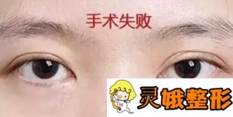 【需警惕】双眼皮手术虽普遍，但美丽和风险并存