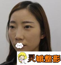石家庄市第四医院整形美容科价格表2020版及隆鼻真人案例