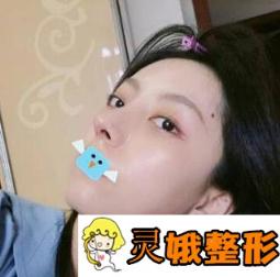 石家庄市第四医院整形美容科价格表2020版及隆鼻真人案例