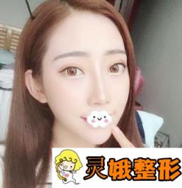 石家庄市第四医院整形美容科价格表2020版及隆鼻真人案例