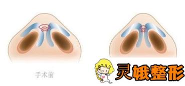 鼻翼宽怎么办？几种方法帮你摆脱鼻翼宽大的烦恼