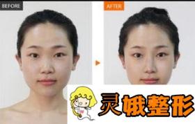 鼻翼宽怎么办？几种方法帮你摆脱鼻翼宽大的烦恼