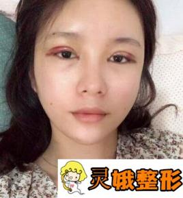 台州美姿整形医院双眼皮案例
