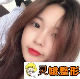 台州美姿整形医院双眼皮案例