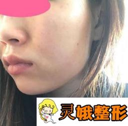 南阳美莱整形医院削骨 