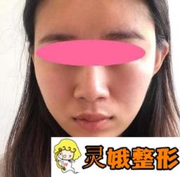 南阳美莱整形医院削骨 