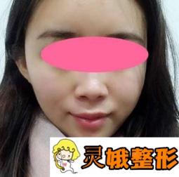 南阳美莱整形医院削骨 