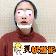 兰州大学第二医院整形科假体垫下巴案例