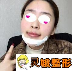 兰州大学第二医院整形科假体垫下巴案例