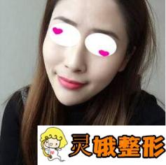 兰州大学第二医院整形科假体垫下巴案例