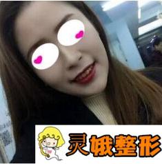 兰州大学第二医院整形科假体垫下巴案例